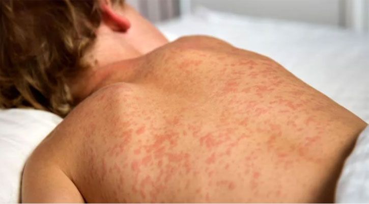 হাম উপসর্গে আরও ৮ শিশুর মৃত্যু